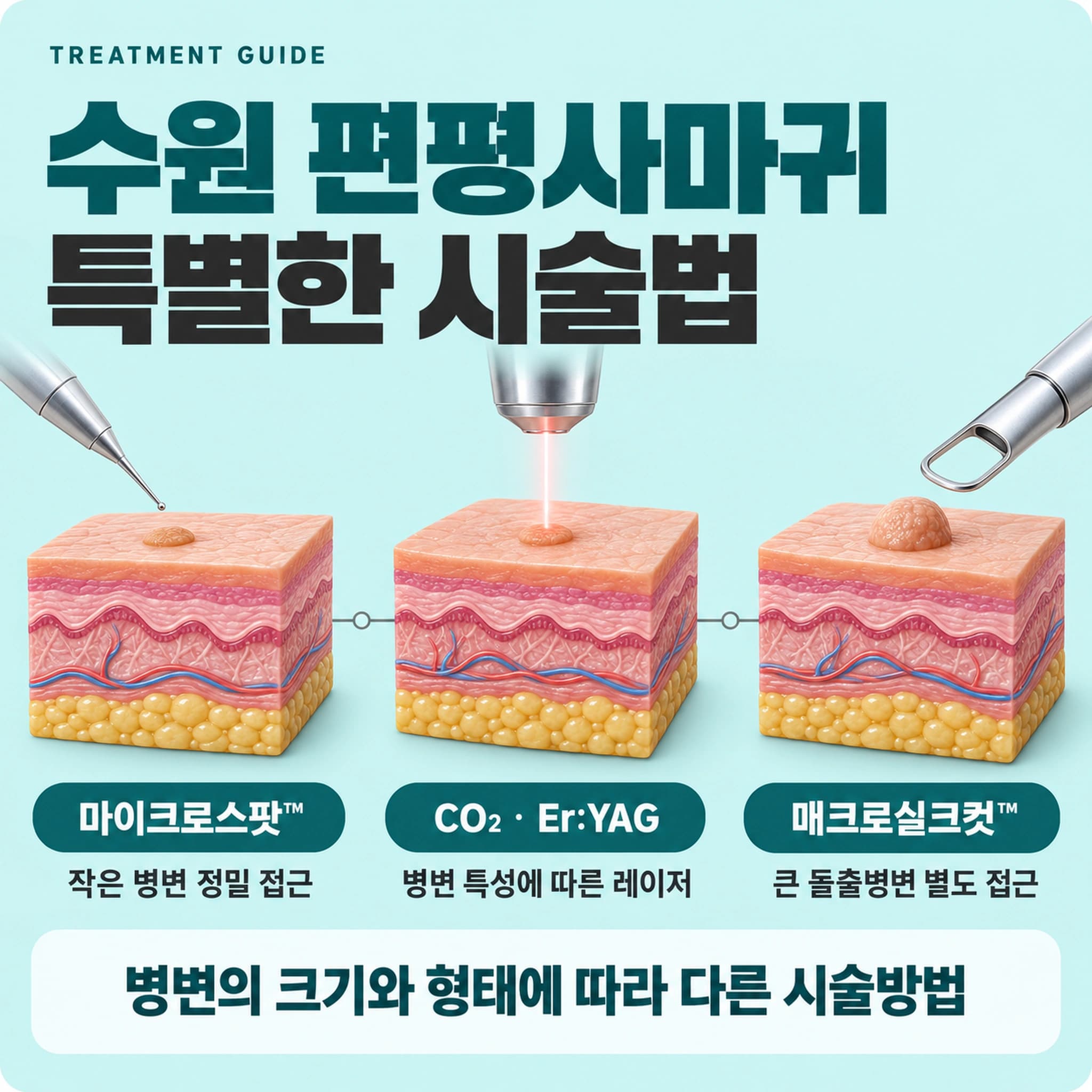 수원 편평사마귀 특별한 시술법