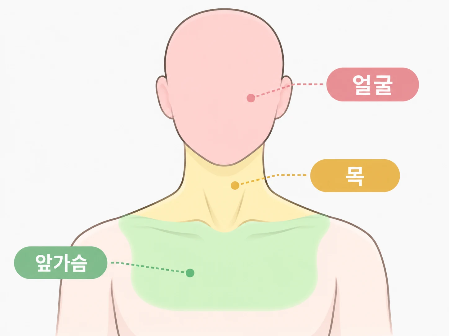 얼굴 목 앞가슴 편평사마귀 쥐젖 무제한 시술 부위